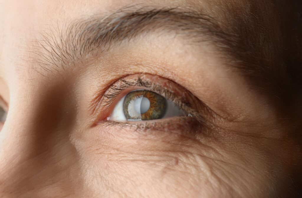 a close up on a woman with a cloudy lens, a symptom of cataracts