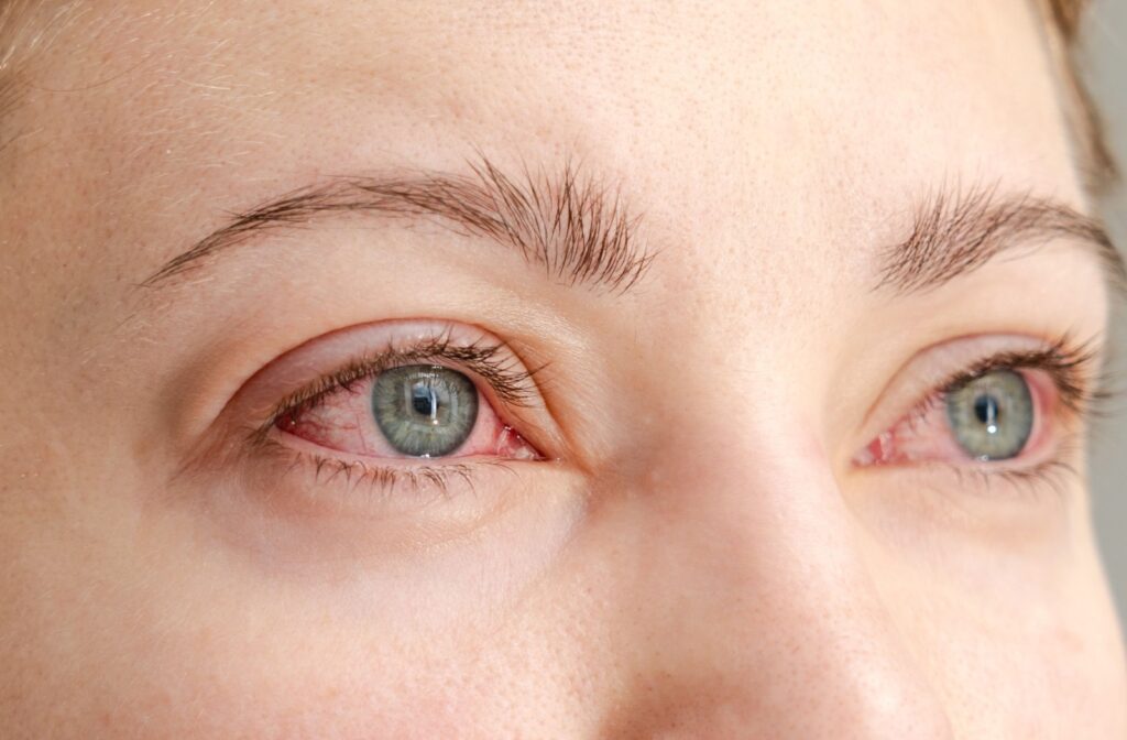 Close-up of someone's red, irritated eyes, possibly due to allergies or an infection.