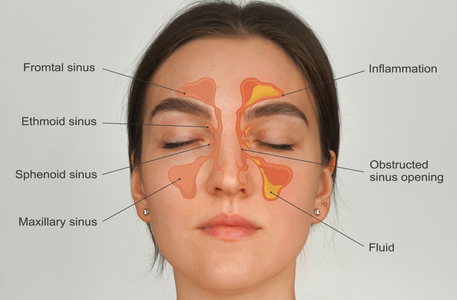 A diagram showing the sinuses and their proximity to the eyes.